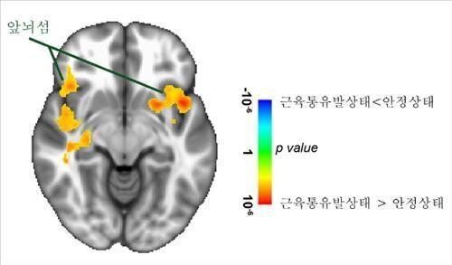 꾀병으로 오인 받아온 섬유근육통의 원인을 찾았다