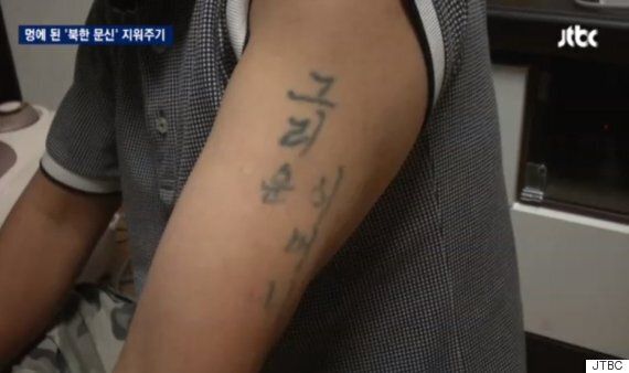 '북한표 문신'을 공짜로 지워주는 성형외과 의사들