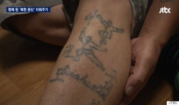 '북한표 문신'을 공짜로 지워주는 성형외과 의사들