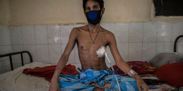 DHAKA, BANGLADESH - 2017/03/24: AMIR HOSSAIN (45) has been suffering from TB for last 2 months at National Institute of Diseases of Chest and Hospital on World Tuberculosis Day in Dhaka, Bangladesh, Friday, March 24, 2017. He receives daily injections and has tube put into infected lung to drain that. Tuberculosis (TB) is a worldwide public health problem. The incident of TB is much higher in developing countries such as Bangladesh. The country ranks sixth among 22 highest burden TB countries in
