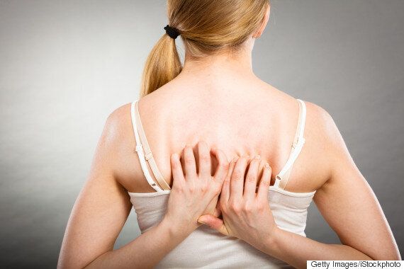 어른이 되고 나서도 ‘아토피'를 겪는 사람의 절실한 고백