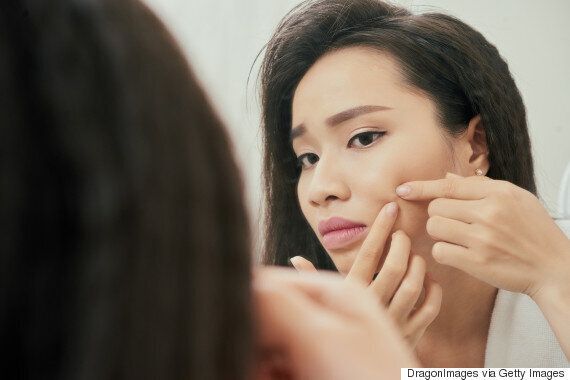 피부 전문가들이 추천하는 여드름을 잘 짜는 방법