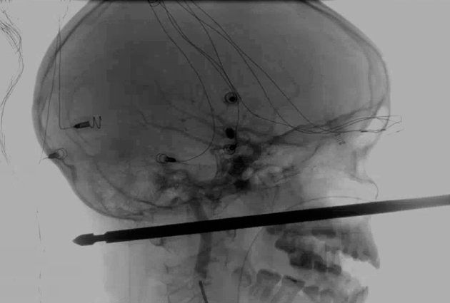 하비에르 커닝햄의 머리를 관통한 쇠꼬챙이 엑스레이 사진