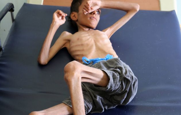 심각한 영양실조를 겪고 있는 예멘 소년 카지 알리 빈 알리(10)가 타이즈(Taiz) 외곽의 한 병원 침대에 누워있다. 2018년 10월30일.