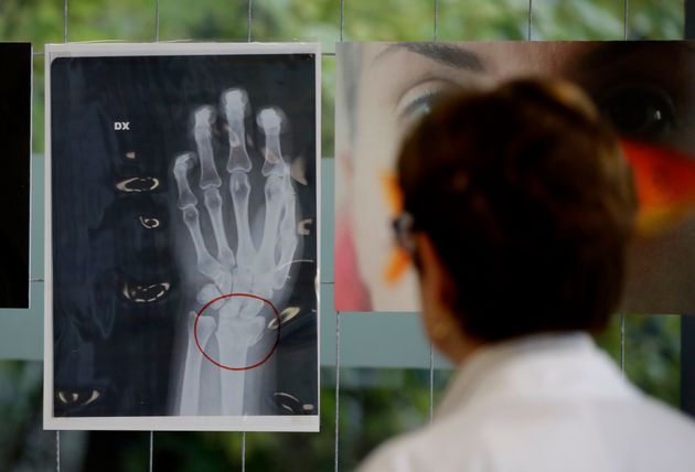 A doctor looks at an x-ray of a woman's broken wrist displayed during the exhibition 'Invisibility is not a super power' which includes x-ray's of anonymous women who arrived at the hospital's emergency room claiming to be victims of violence, at the San Carlo Hospital, in Milan, Italy, Friday, Nov. 22, 2019. The exhibition, a combination of photographs and x-rays, was promoted on the occasion of the International day for the Elimination of Violence Against Women which takes place on Nov. 25.  (AP Photo/Luca Bruno)