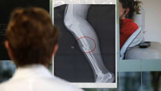A doctor looks at an x-ray of a woman's broken leg displayed during the exhibition 'Invisibility is not a super power' which includes x-ray's of anonymous women who arrived at the hospital's emergency room claiming to be victims of violence, at the San Carlo Hospital, in Milan, Italy, Friday, Nov. 22, 2019. The exhibition, a combination of photographs and x-rays, was promoted on the occasion of the International day for the Elimination of Violence Against Women which takes place on Nov. 25.  (AP Photo/Luca Bruno)