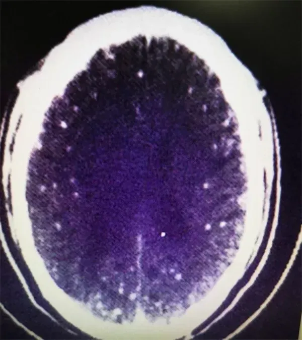 주씨 뇌 CT사진