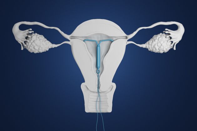루프를 설치한 자궁의 모습