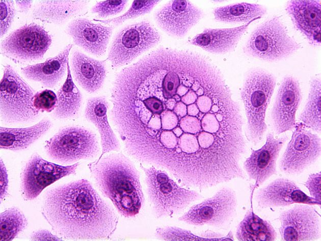 HPV 감염으로 변형된 상피 세포의 모습