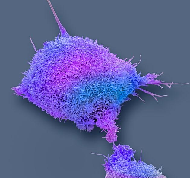 자궁경부암 세포의 모습