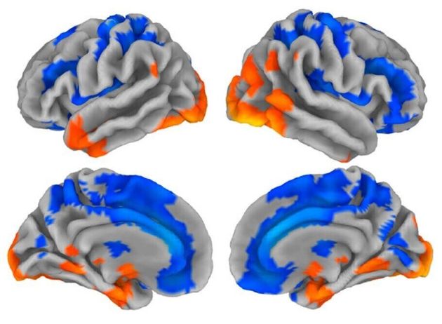 아민 라즈나한 연구팀의 논문에 수록된 이미지. 22~35살 남녀 488명씩의 뇌를 분석해 하나의 뇌 표면과 단면으로 그려낸 그림이다. 윗줄은 좌뇌와 우뇌의 표면이고, 아랫줄은 각각 좌뇌와 우뇌의 단면이며 좌와 우는 세로축을 중심으로 대칭된다. 파란색의 회백질 영역에서는 통상 여성이 남성보다 부피가 크게 나타나며 주황색 영역은 반대로 남성이 여성보다 부피가 더 크게 나타나는 것으로 조사됐다. 하나의 뇌 이미지에 여성의 뇌와 남성의 뇌에서 상대적으로 회백질이 발달한 부위를 함께 표시함으로써 남녀의 뇌가 다르다는 점을 강조한다. 이러한 해부학적 차이는 남녀의 능력 차이를 설명하는 원인이기보다 성별에 따라 다르게 외부의 영향을 받은 결과일 수 있다.