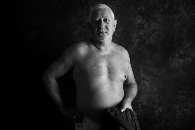 카디프 주민 스티브 맥알리스터(67세)는 2010년 유방암 진단을 받았다.