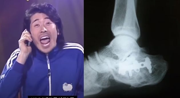 개그맨 고혜성과 그의 발 뒤꿈치 엑스레이 