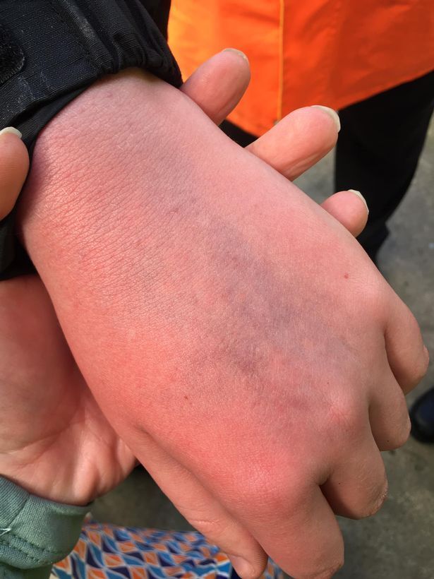 크리스티아누 호날두의 폭행 직후 멍이 들고 부어오른 제이크의 손.