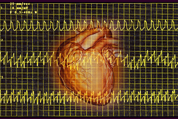 Atrial tachycardia electrocardiogram, heart rhythm disorder where the patient complains of rapid palpitation sensations. (Photo by: CAVALLINI JAMES/BSIP/Universal Images Group via Getty Images)