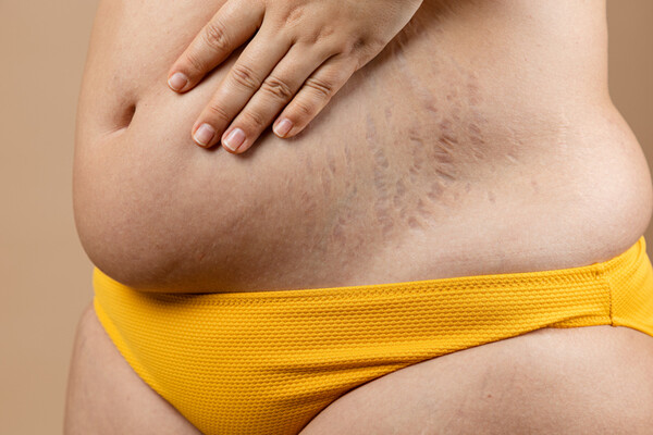 튼 살, 복부지방 등 신체 변화를 겪는 산후 여성들. ⓒGetty