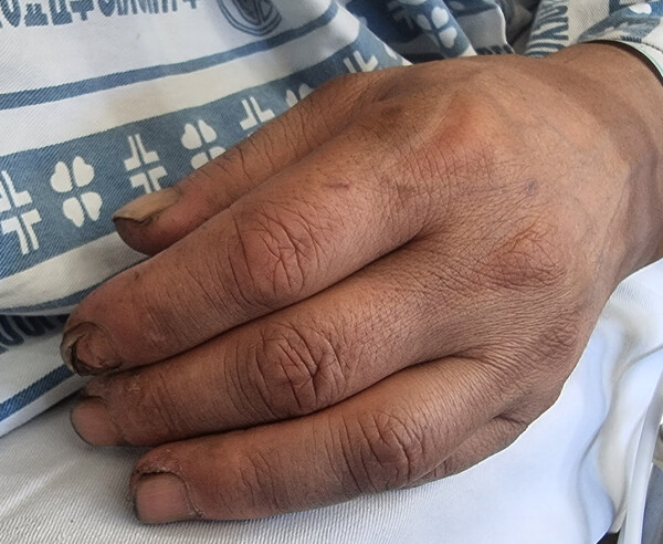 경북 봉화군 아연광산 매몰 사고로 고립됐다 221시간 만에 생환해 안동병원에서 치료 중인 작업반장 박모씨(62)가 5일 오후 병실에서 휴식하고 있다. 사진은 27년 광부로 일한 박씨의 손. ⓒ박모씨 가족 제공&nbsp;