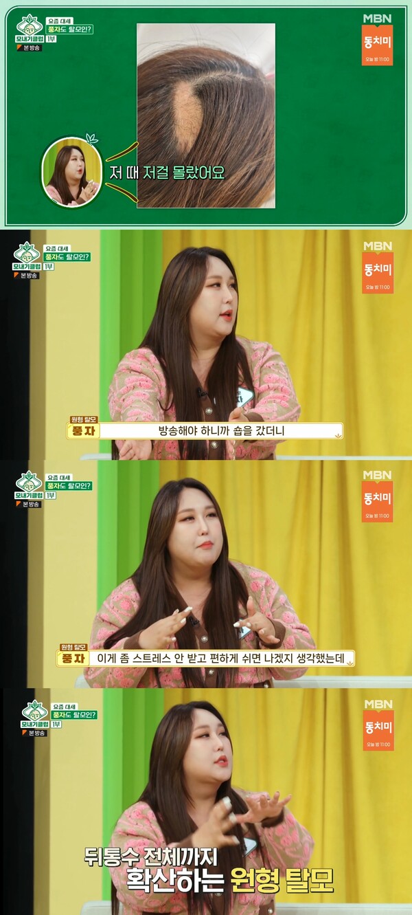 당시 풍자는 원형탈모가 온 것도 모르고 있었다. ⓒ‘모내기클럽’