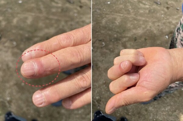 농장주 양씨가 지난달 26일 개에게 물려 절단됐던 손가락을 보여주고 있다. 절단된 손가락은 무사히 접합됐지만 주먹이 온전히 쥐어지지 않는 장애를 남겼다. ⓒ한겨레&nbsp;