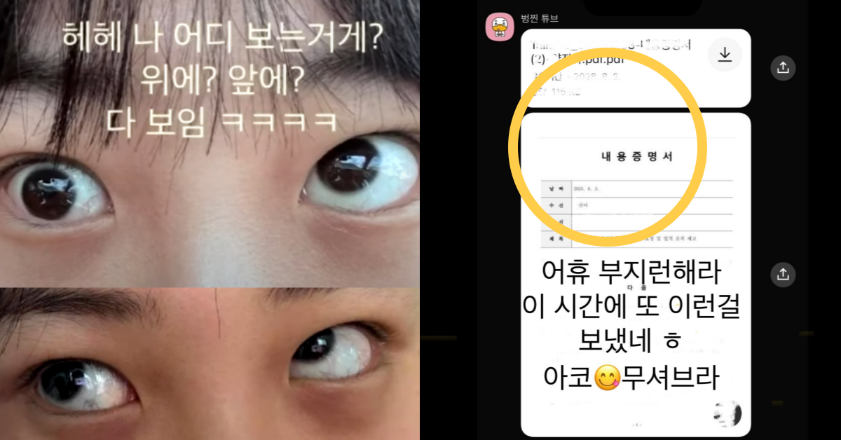 눈 밑 지방 제거 수술 이후 사시 증상이 생긴 제보자. ⓒ제보자 스레드 계정