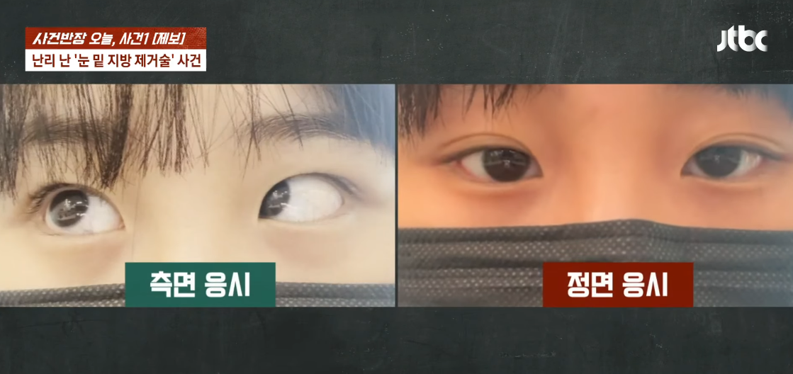 제보자의 사시 증상. ⓒJTBC ‘사건반장’