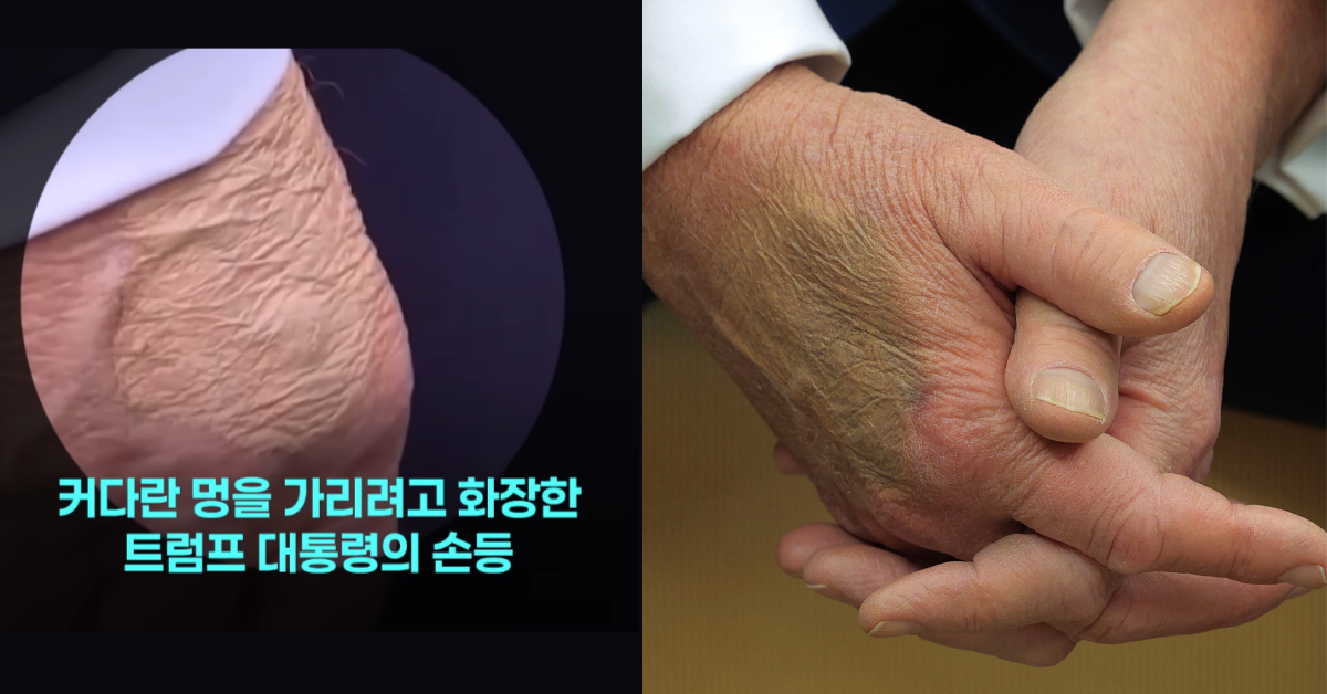 손등 멍 자국으로 화제가 됐던 트럼프. ⓒ유튜브 채널 ‘JTBC News’ / 뉴스1