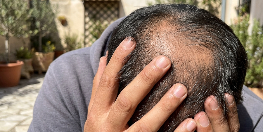 다가오는 여름, 내리쬐는 햇볕과 빠지는 머리카락의 상관관계 : 필수 용품과 대처법, 예방습관