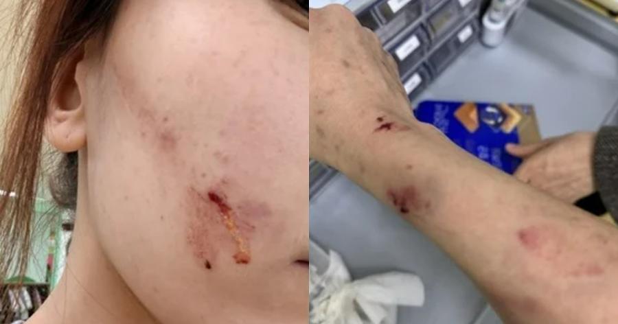유치원에서 아이가 교사의 팔을 깨물고 밀쳐 뇌진탕 진단 : 부모는 교사를 '아동학대'로 신고했다